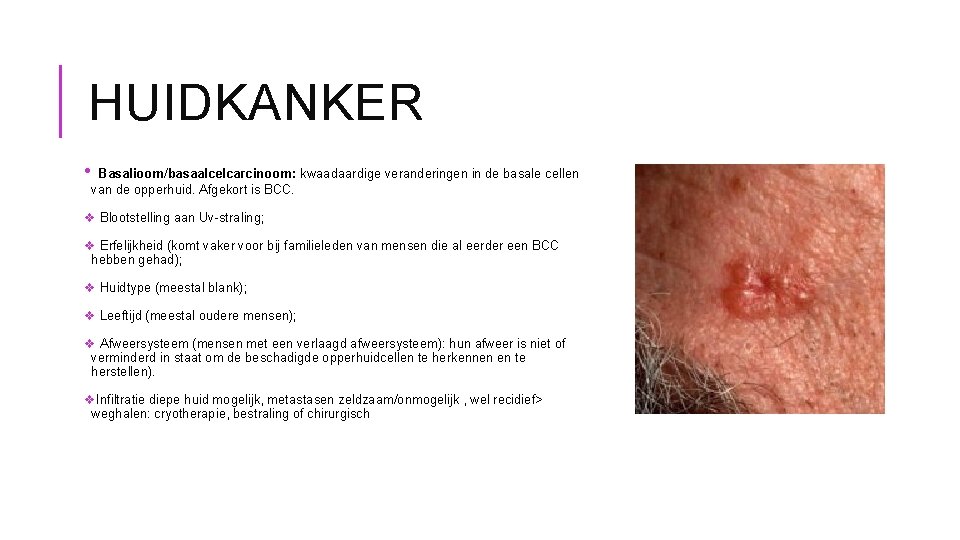 HUIDKANKER • Basalioom/basaalcelcarcinoom: kwaadaardige veranderingen in de basale cellen van de opperhuid. Afgekort is
