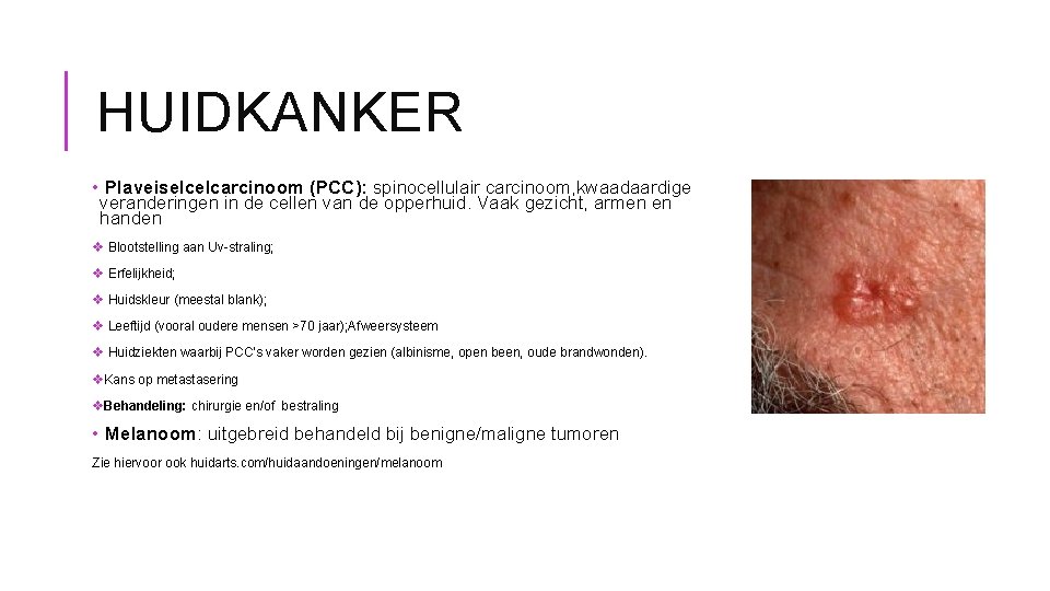 HUIDKANKER • Plaveiselcelcarcinoom (PCC): spinocellulair carcinoom, kwaadaardige veranderingen in de cellen van de opperhuid.