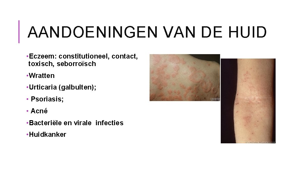 AANDOENINGEN VAN DE HUID • Eczeem: constitutioneel, contact, toxisch, seborroïsch • Wratten • Urticaria