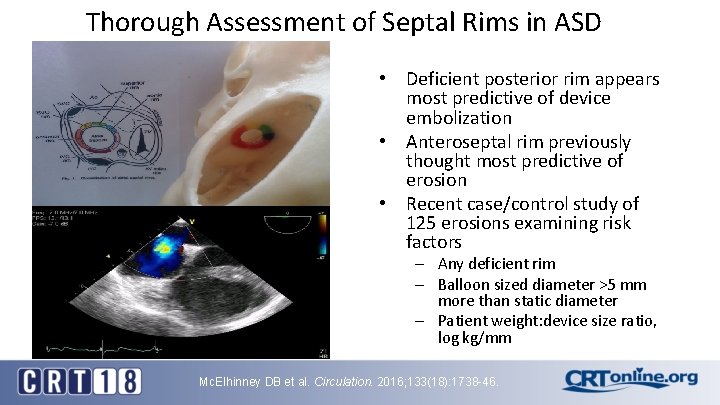 Thorough Assessment of Septal Rims in ASD • Deficient posterior rim appears most predictive