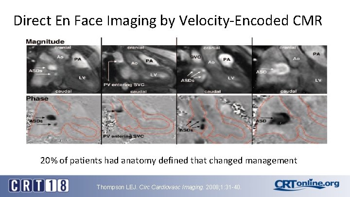 Direct En Face Imaging by Velocity-Encoded CMR 20% of patients had anatomy defined that