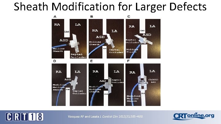 Sheath Modification for Larger Defects Vasquez AF and Lasala J. Cardiol Clin 2013; 31: