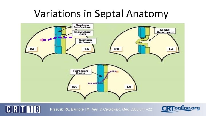 Variations in Septal Anatomy Krasuski RA, Bashore TM Rev. in Cardiovasc. Med. 2005; 6: