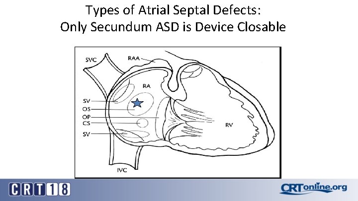 Types of Atrial Septal Defects: Only Secundum ASD is Device Closable 