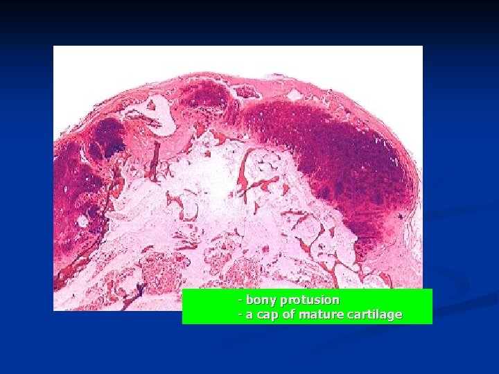 - bony protusion - a cap of mature cartilage 