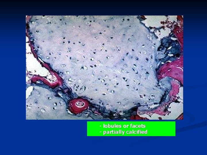- lobules or facets - partially calcified 