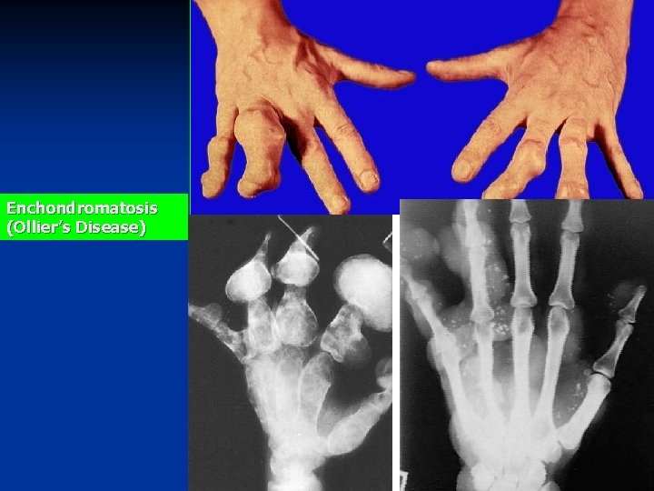 Enchondromatosis (Ollier’s Disease) 