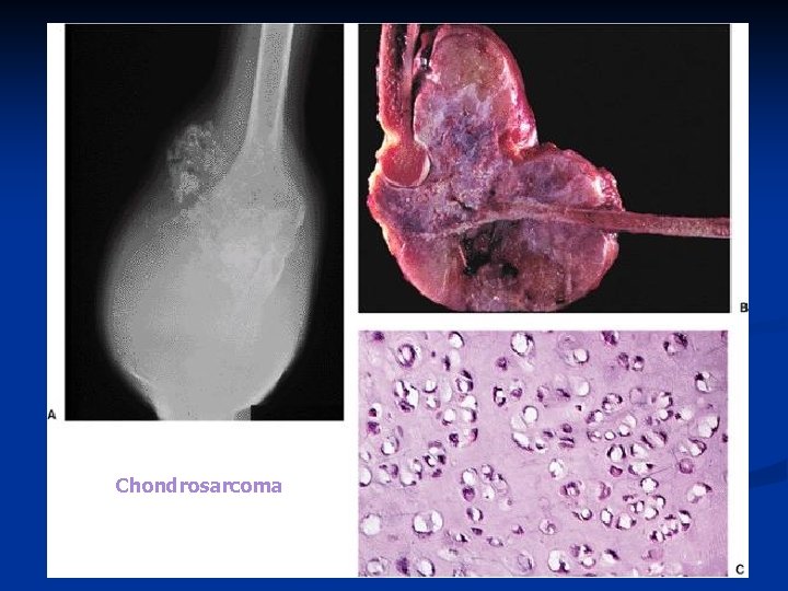 Chondrosarcoma 