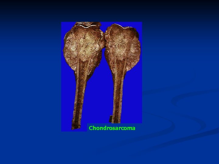 Chondrosarcoma 