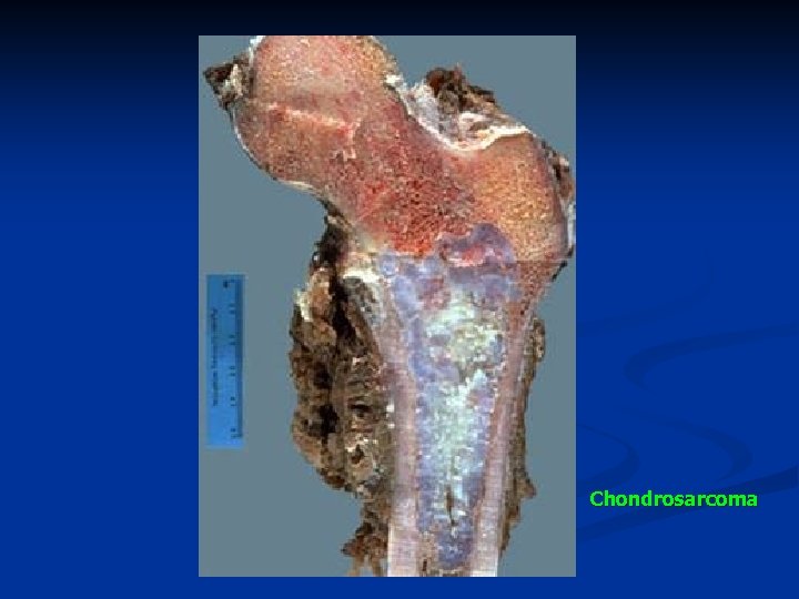 Chondrosarcoma 