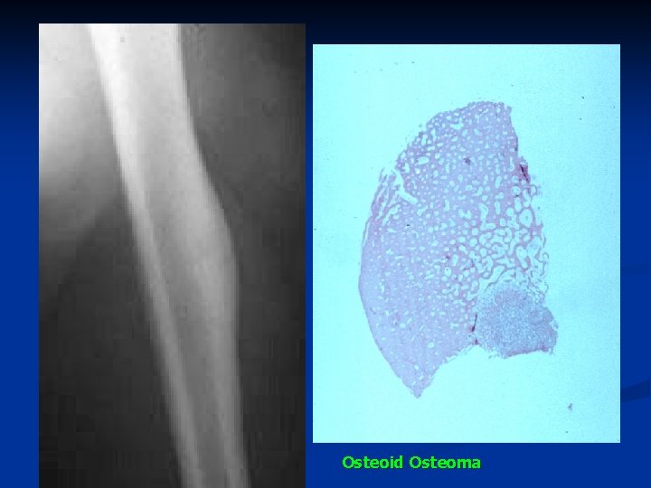 Osteoid Osteoma 