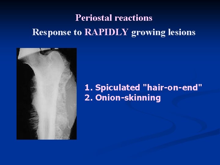 Periostal reactions Response to RAPIDLY growing lesions 1. Spiculated "hair-on-end" 2. Onion-skinning 