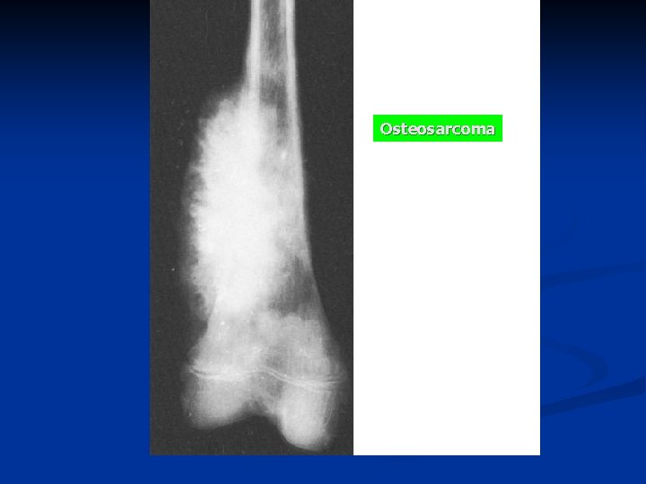 Osteosarcoma 