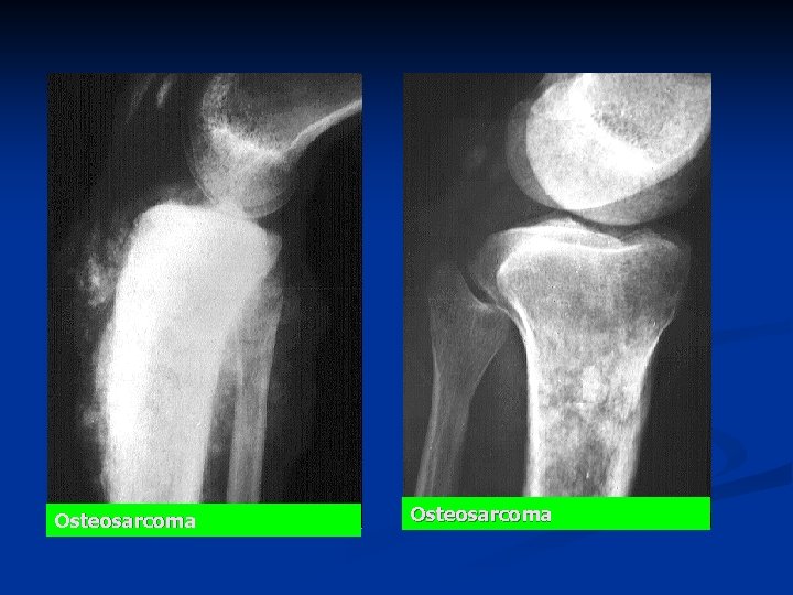 Osteosarcoma 