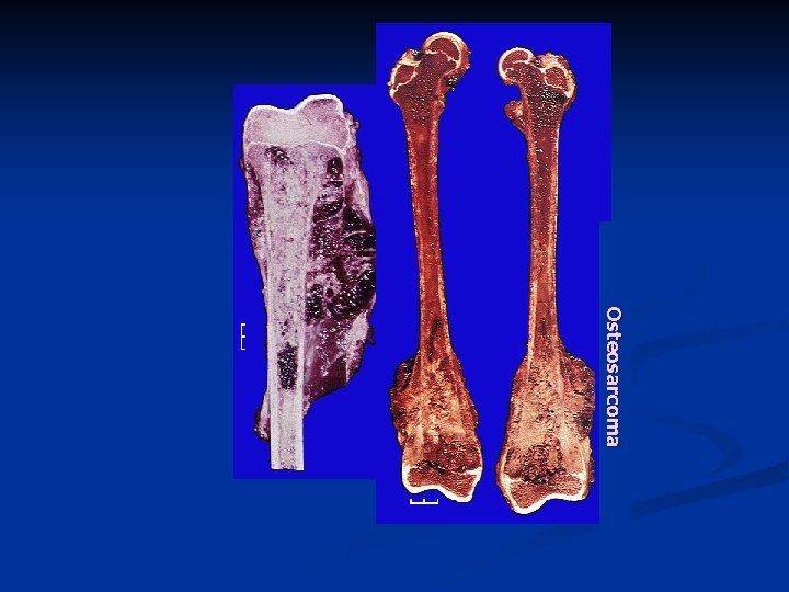 Osteosarcoma 