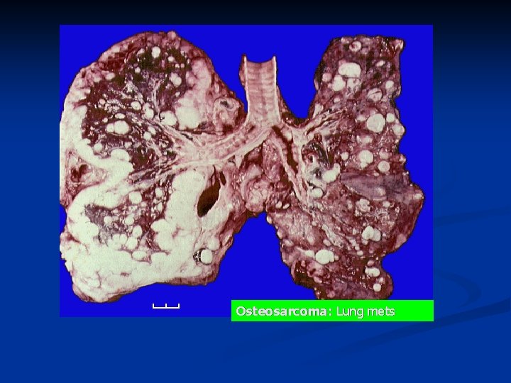 Osteosarcoma: Lung mets 