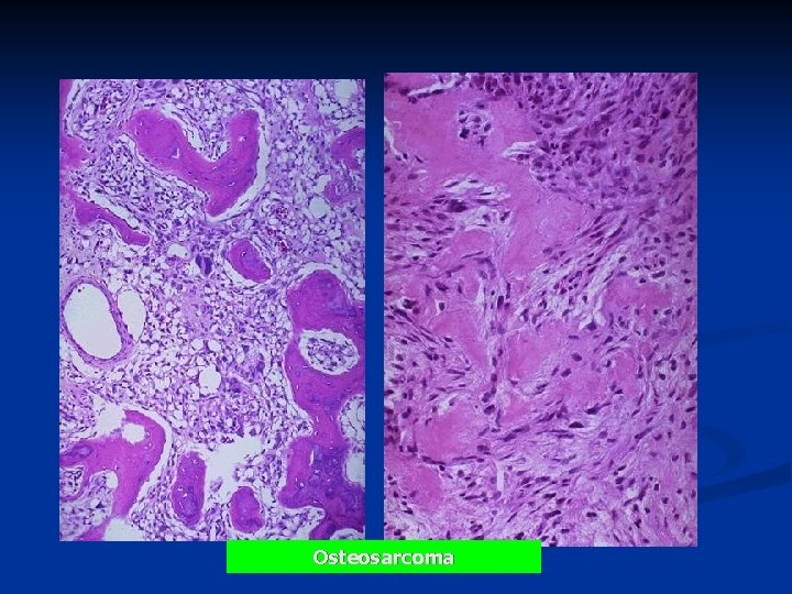Osteosarcoma 