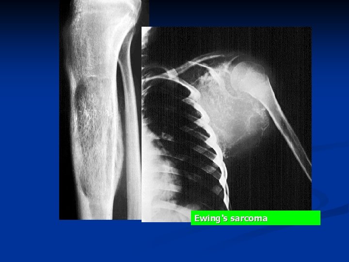 Ewing's sarcoma 