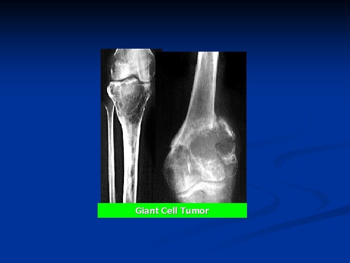 Giant Cell Tumor 