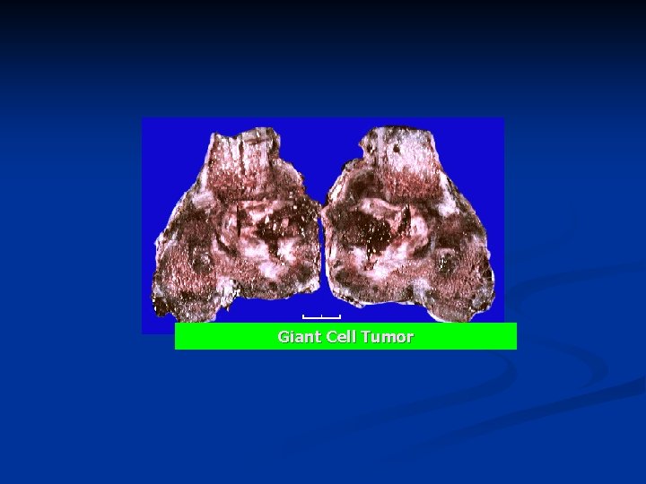 Giant Cell Tumor 