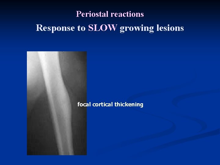 Periostal reactions Response to SLOW growing lesions focal cortical thickening 