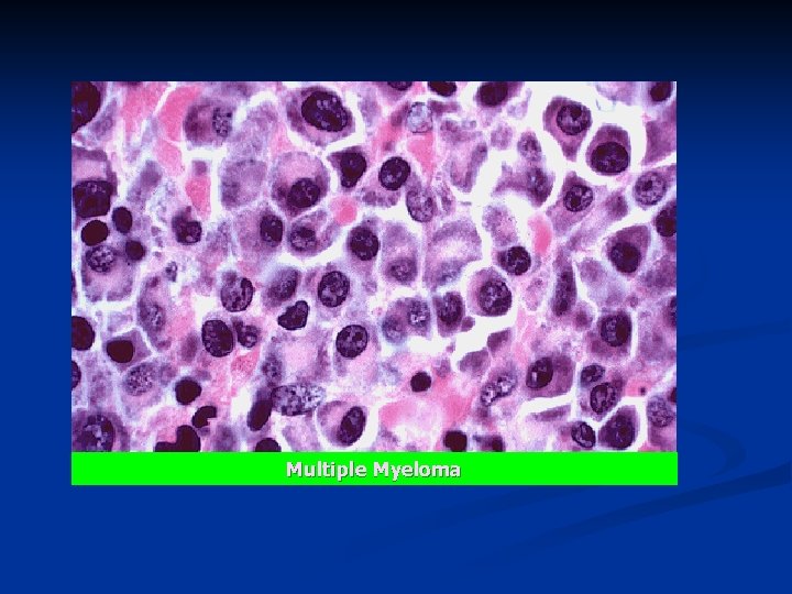 Multiple Myeloma 