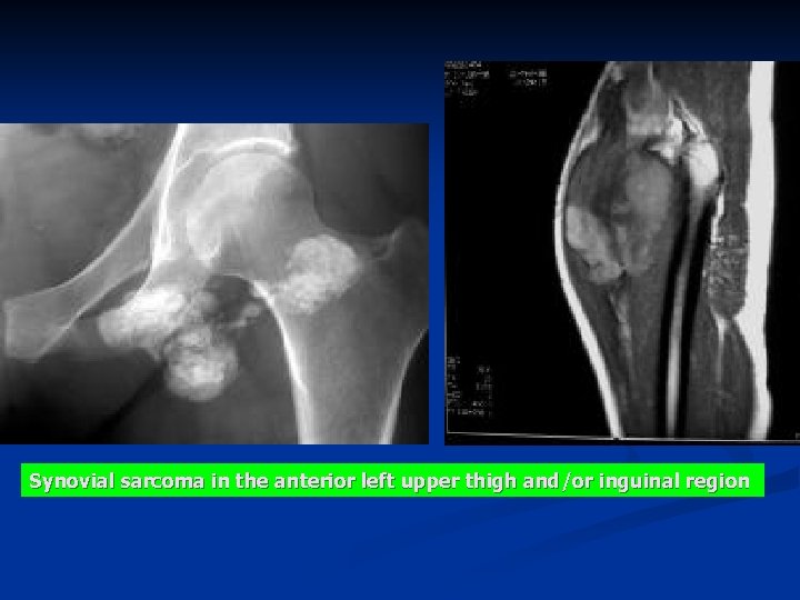 Synovial sarcoma in the anterior left upper thigh and/or inguinal region 