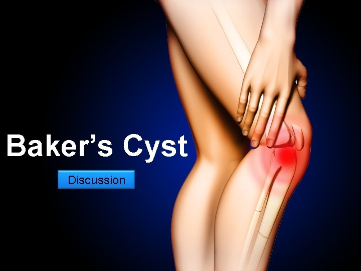 Baker’s Cyst Discussion 