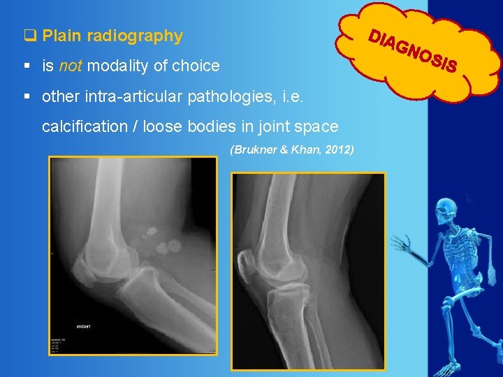 DIA q Plain radiography GN § is not modality of choice § other intra-articular