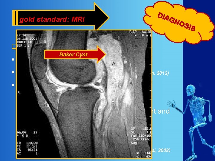 gold standard: MRI DIA GN q Magnetic Resonance Imaging (MRI) Baker Cyst § diagnosis