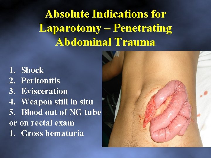 Absolute Indications for Laparotomy – Penetrating Abdominal Trauma 1. Shock 2. Peritonitis 3. Evisceration