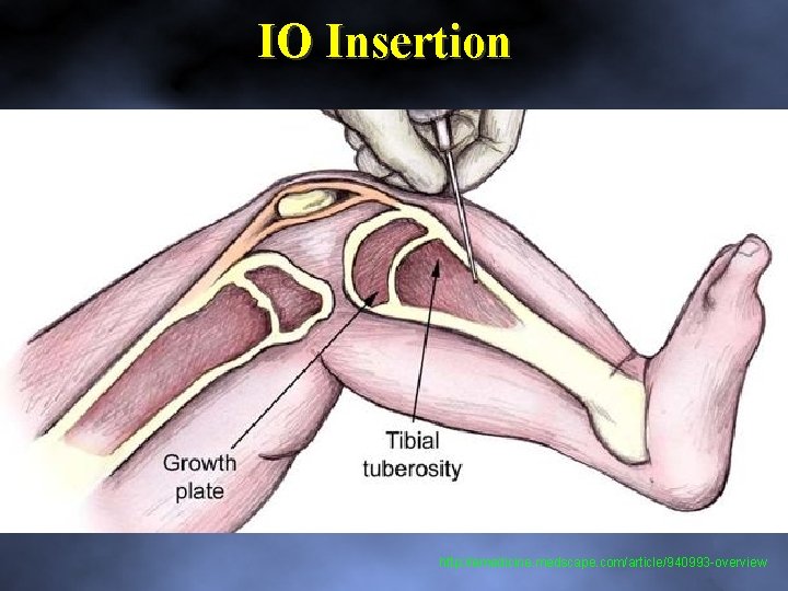 IO Insertion http: //emedicine. medscape. com/article/940993 -overview 