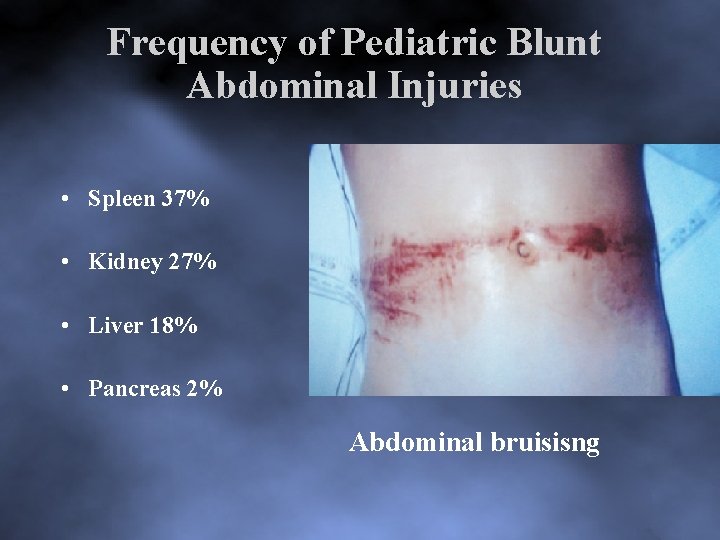 Frequency of Pediatric Blunt Abdominal Injuries • Spleen 37% • Kidney 27% • Liver