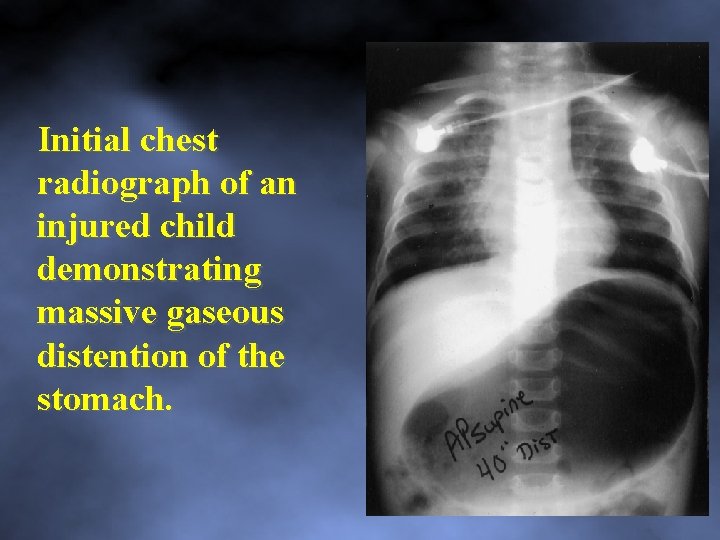 Initial chest radiograph of an injured child demonstrating massive gaseous distention of the stomach.