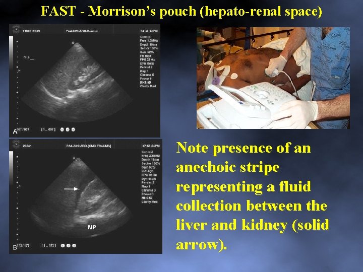 FAST Morrison’s pouch (hepato renal space) Note presence of an anechoic stripe representing a