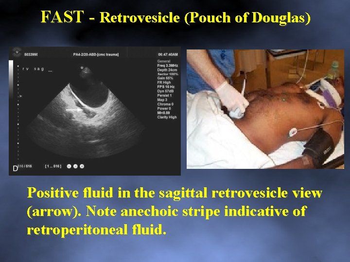 FAST Retrovesicle (Pouch of Douglas) Positive fluid in the sagittal retrovesicle view (arrow). Note