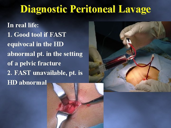 Diagnostic Peritoneal Lavage In real life: 1. Good tool if FAST equivocal in the
