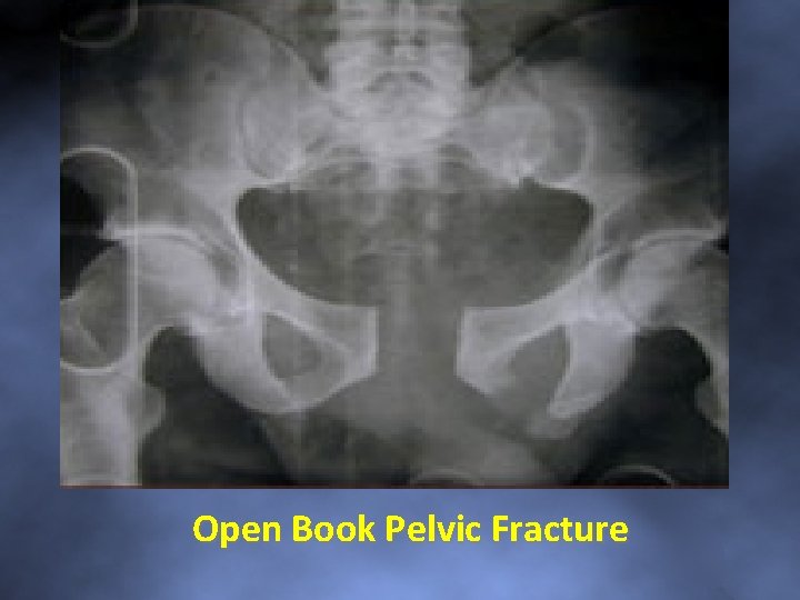 Open Book Pelvic Fracture 