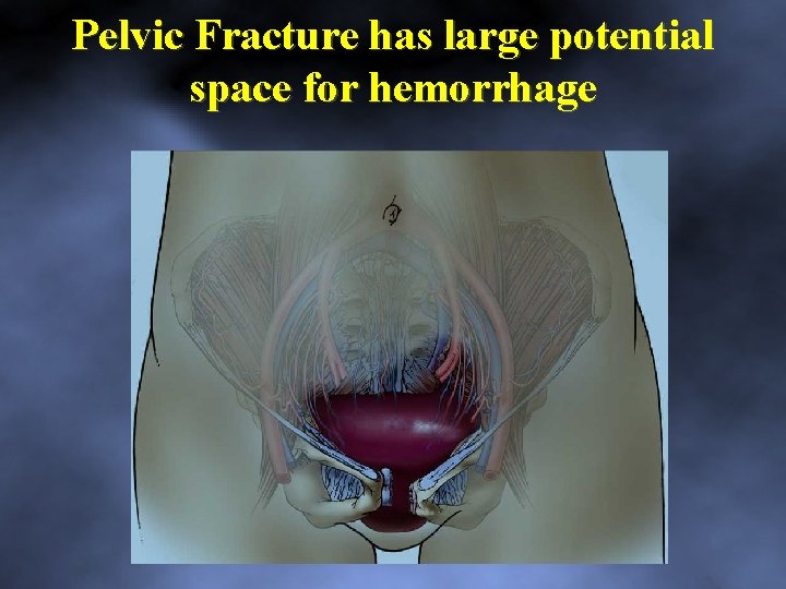 Pelvic Fracture has large potential space for hemorrhage 