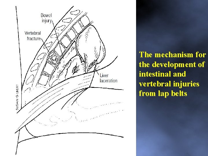 The mechanism for the development of intestinal and vertebral injuries from lap belts 