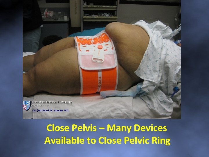 Col (ret) Mark W. Bowyer MD Close Pelvis – Many Devices Available to Close