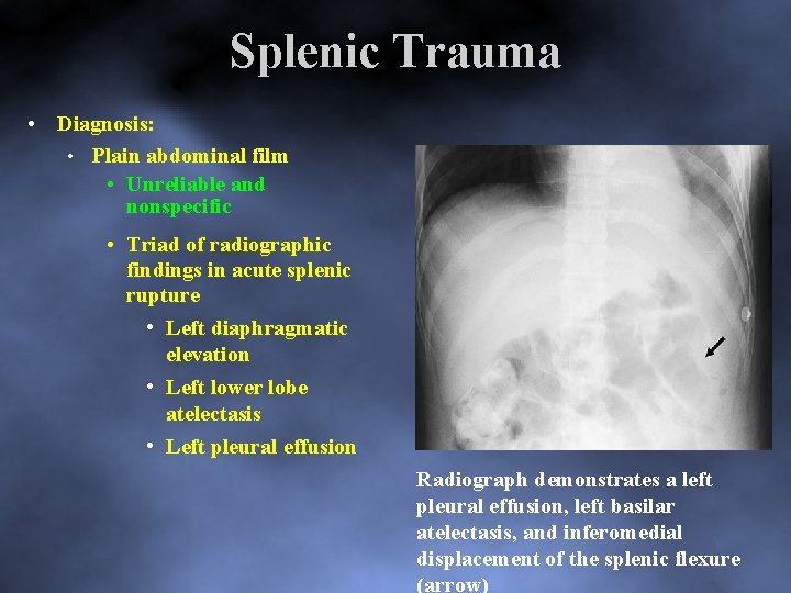 Splenic Trauma • Diagnosis: • Plain abdominal film • Unreliable and nonspecific • Triad