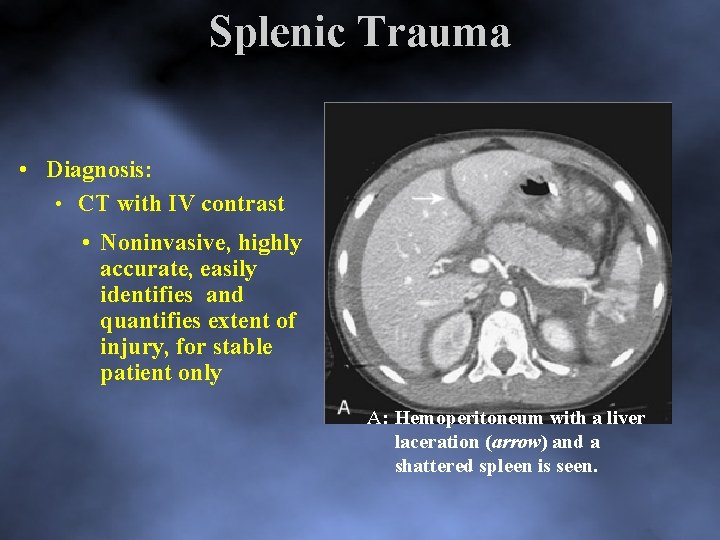 Splenic Trauma • Diagnosis: • CT with IV contrast • Noninvasive, highly accurate, easily