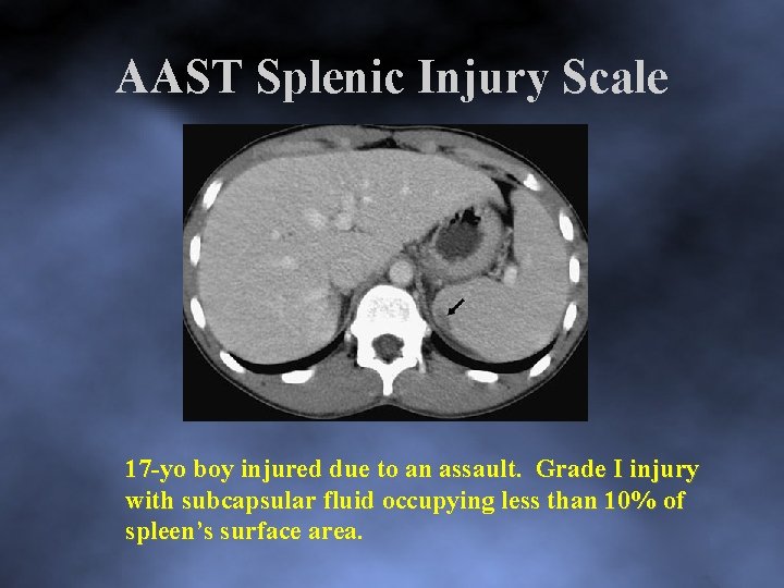 AAST Splenic Injury Scale 17 yo boy injured due to an assault. Grade I