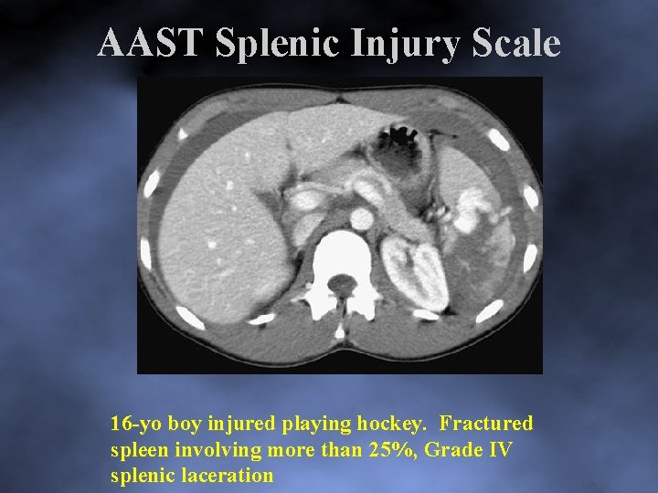 AAST Splenic Injury Scale 16 yo boy injured playing hockey. Fractured spleen involving more