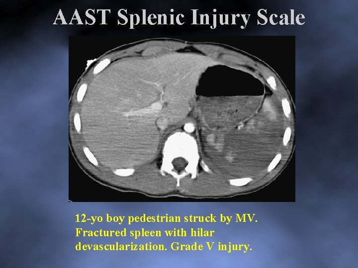 AAST Splenic Injury Scale 12 yo boy pedestrian struck by MV. Fractured spleen with