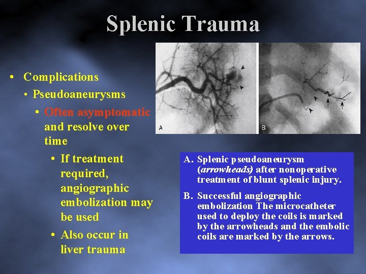 Splenic Trauma • Complications • Pseudoaneurysms • Often asymptomatic and resolve over time •