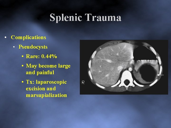 Splenic Trauma • Complications • Pseudocysts • Rare: 0. 44% • May become large