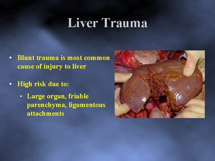 Liver Trauma • Blunt trauma is most common cause of injury to liver •