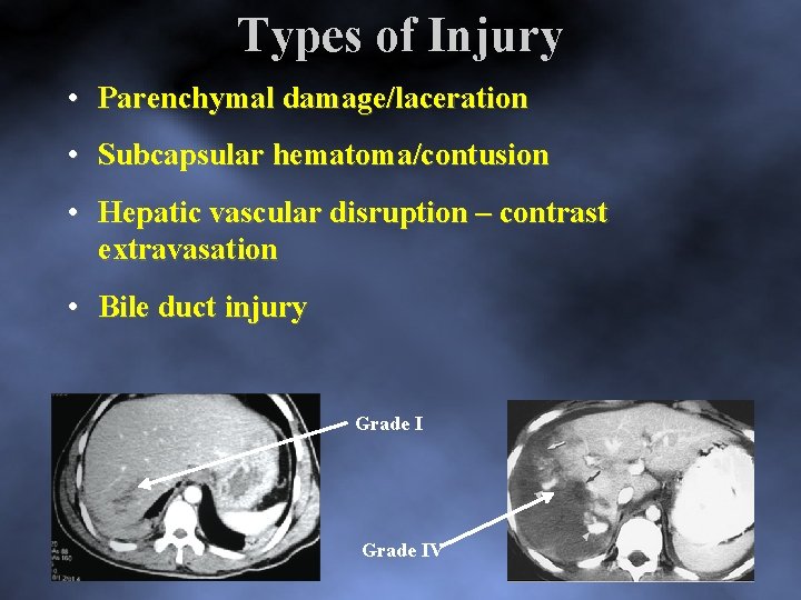 Types of Injury • Parenchymal damage/laceration • Subcapsular hematoma/contusion • Hepatic vascular disruption –